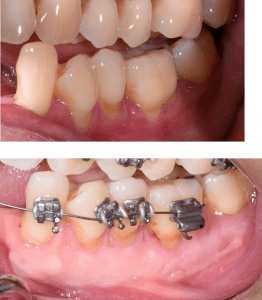 Before/After Gingival Graft
