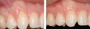 Before/After Gingival Graft