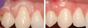 Before/After Gingival Graft