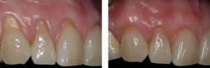 Before/After Gingival Graft