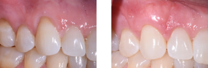 Before/After Gingival Graft