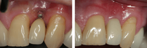 Before/After Gingival Graft